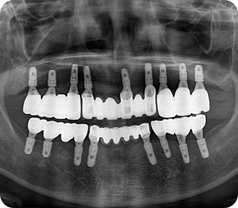 이OO님 라미네이트 후기